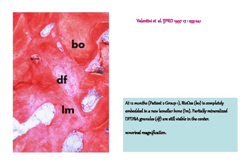 Valentini et al. IJPRD 1997 17 : 233 -241 At 12 months (Patient 2