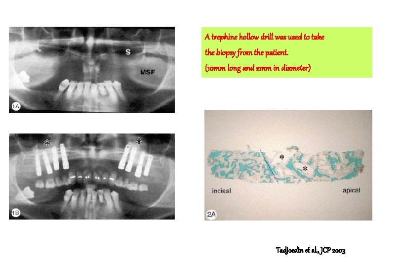 A trephine hollow drill was used to take the biopsy from the patient. (10