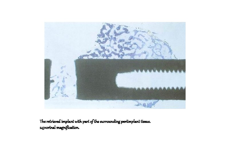 The retrieved implant with part of the surrounding periimplant tissue. 2. 5×orinal magnification. 