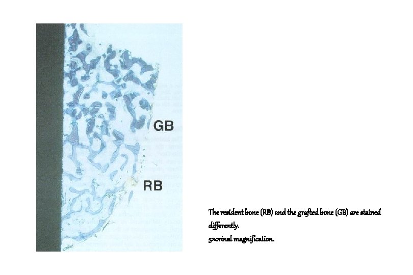 The resident bone (RB) and the grafted bone (GB) are stained differently. 5×orinal magnification.