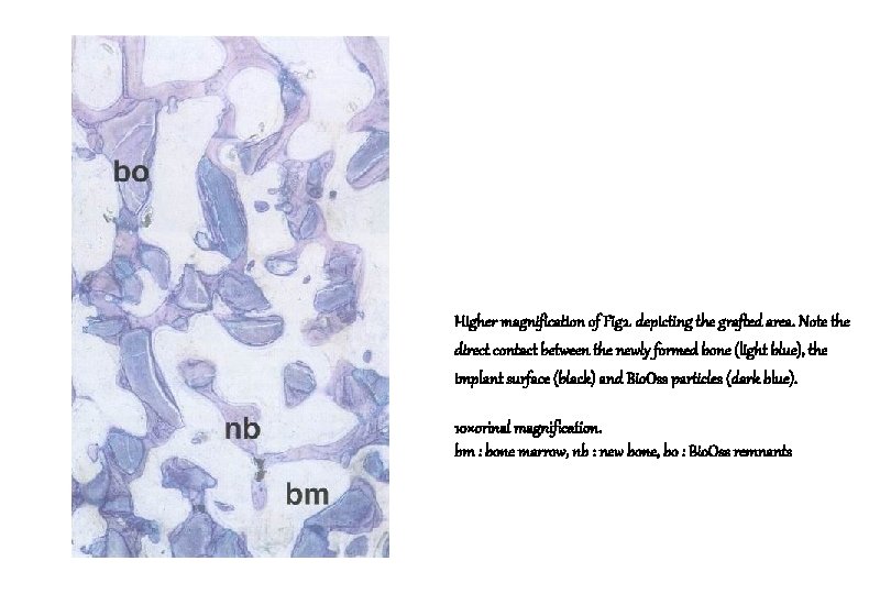 Higher magnification of Fig 2. depicting the grafted area. Note the direct contact between