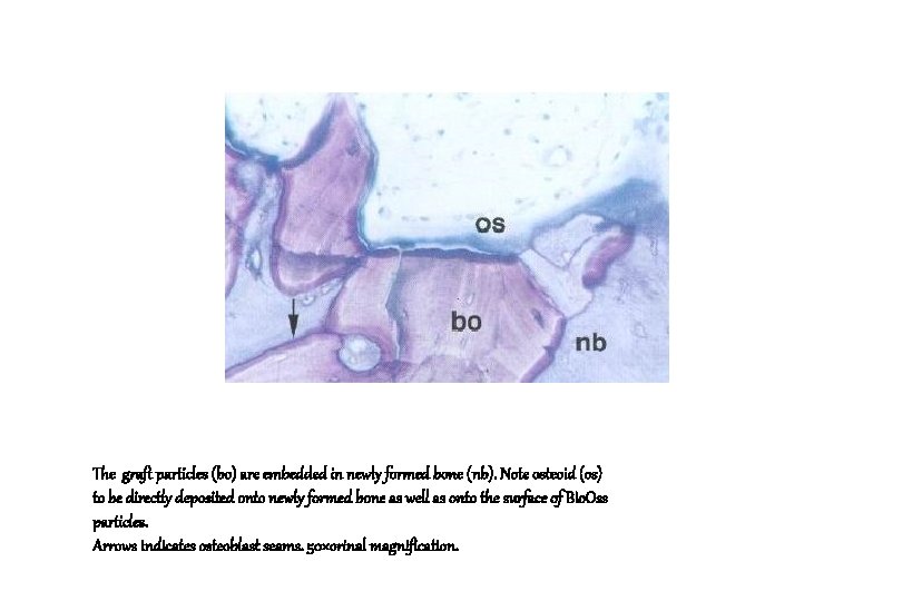 The graft particles (bo) are embedded in newly formed bone (nb). Note osteoid (os)