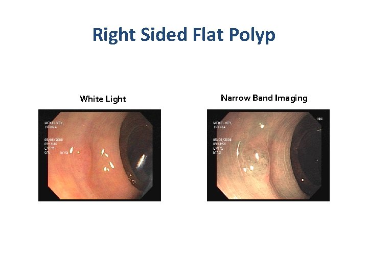 Right Sided Flat Polyp White Light Narrow Band Imaging Right Sided Flat Polyp White Light Narrow Band Imaging