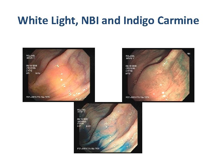 White Light, NBI and Indigo Carmine White Light, NBI and Indigo Carmine