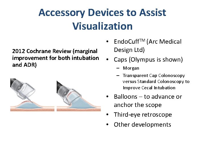 Accessory Devices to Assist Visualization 2012 Cochrane Review (marginal improvement for both intubation and Accessory Devices to Assist Visualization 2012 Cochrane Review (marginal improvement for both intubation and