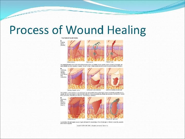 Process of Wound Healing 