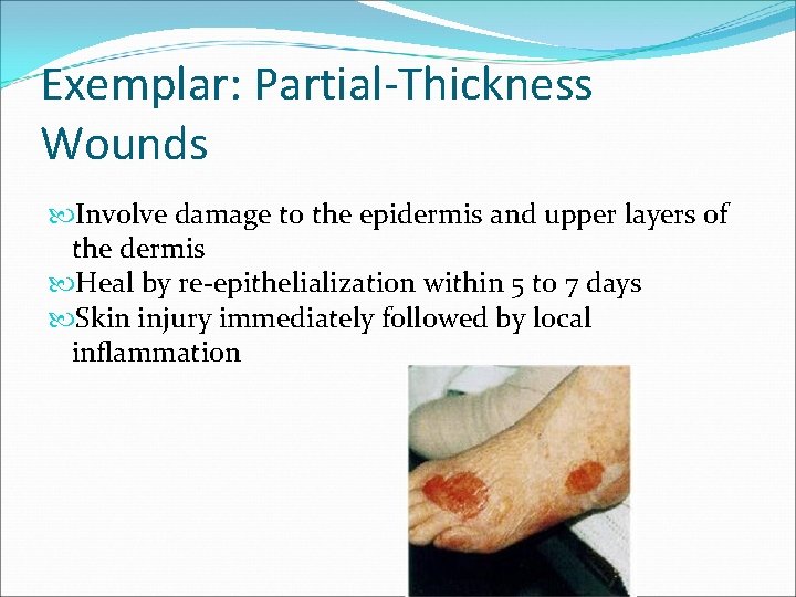 Exemplar: Partial-Thickness Wounds Involve damage to the epidermis and upper layers of the dermis