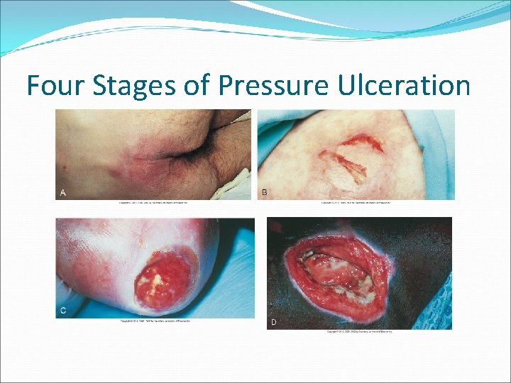 Four Stages of Pressure Ulceration 