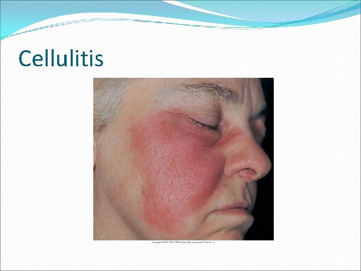 Cellulitis 