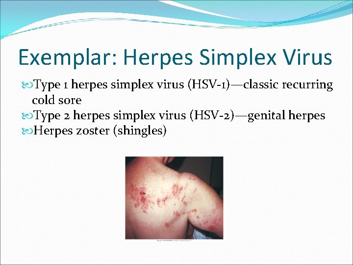 Exemplar: Herpes Simplex Virus Type 1 herpes simplex virus (HSV-1)—classic recurring cold sore Type