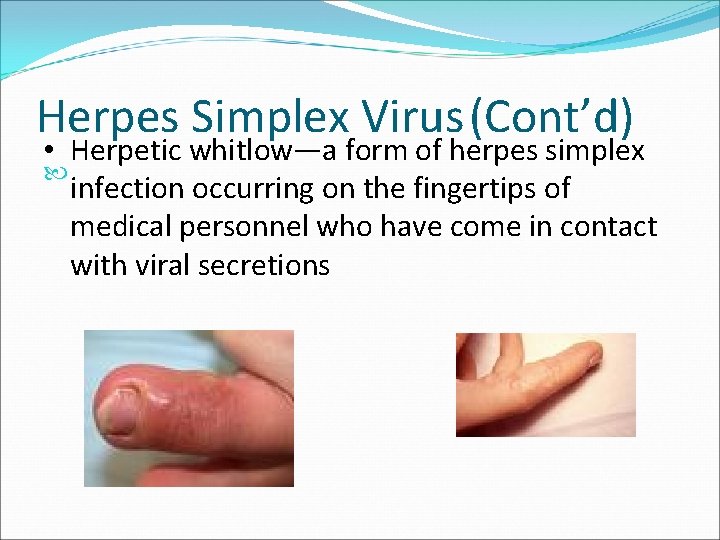 Herpes Simplex Virus (Cont’d) • Herpetic whitlow—a form of herpes simplex infection occurring on