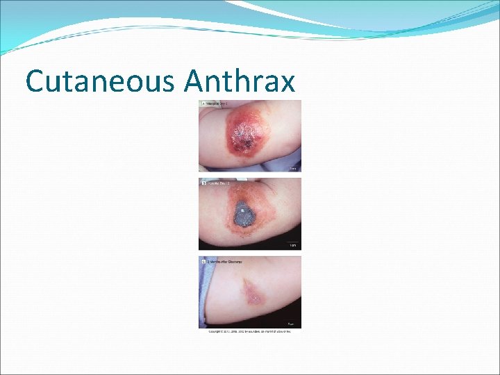 Cutaneous Anthrax 