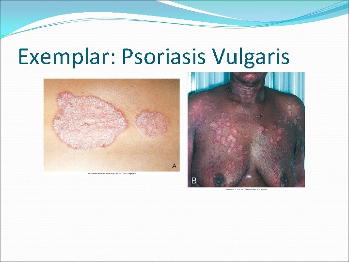 Exemplar: Psoriasis Vulgaris 