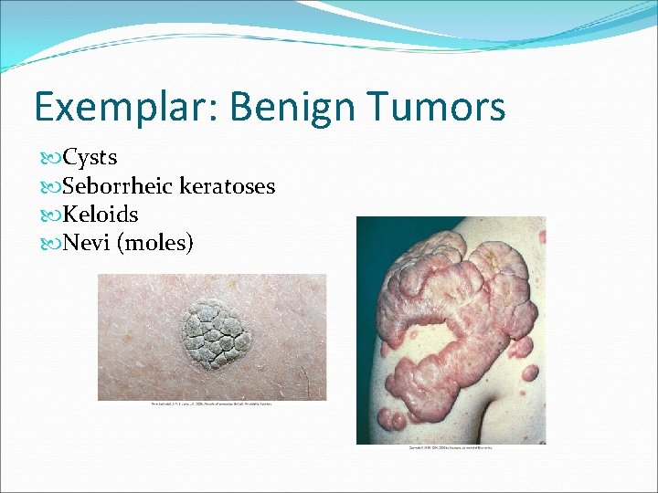 Exemplar: Benign Tumors Cysts Seborrheic keratoses Keloids Nevi (moles) 