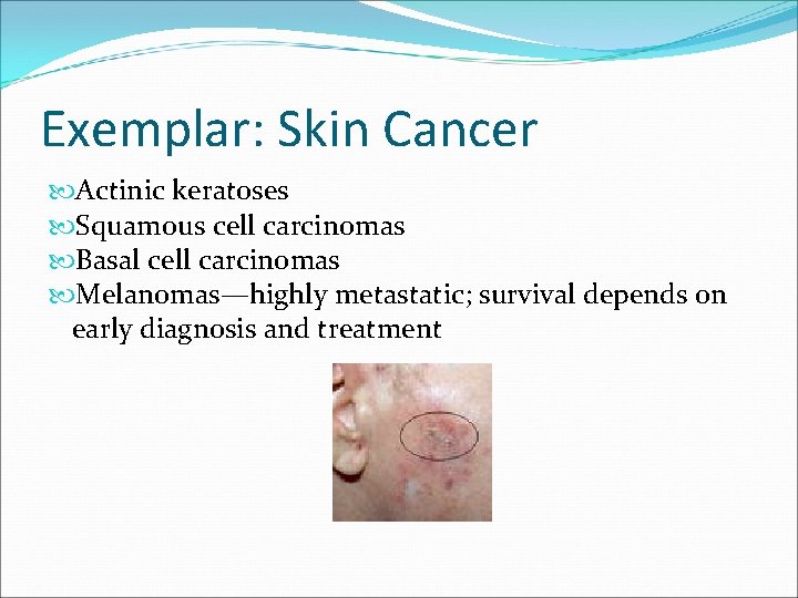 Exemplar: Skin Cancer Actinic keratoses Squamous cell carcinomas Basal cell carcinomas Melanomas—highly metastatic; survival