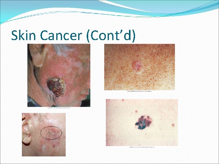 Skin Cancer (Cont’d) 