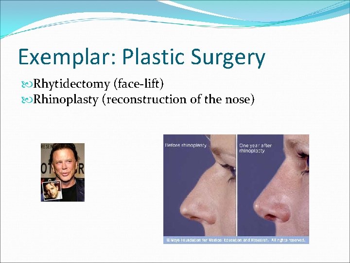 Exemplar: Plastic Surgery Rhytidectomy (face-lift) Rhinoplasty (reconstruction of the nose) 