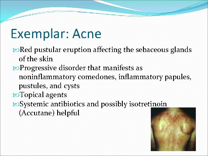 Exemplar: Acne Red pustular eruption affecting the sebaceous glands of the skin Progressive disorder