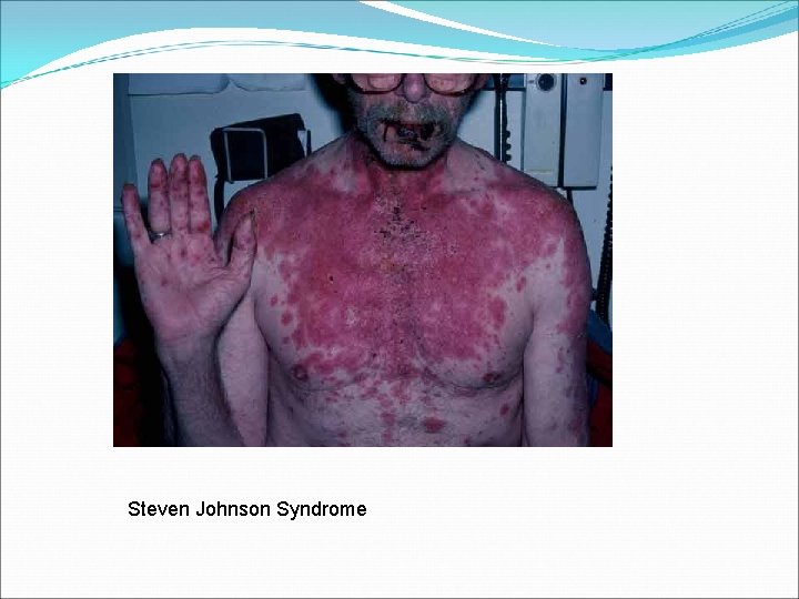 Steven Johnson Syndrome 