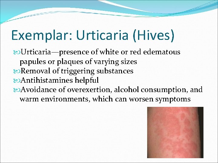 Exemplar: Urticaria (Hives) Urticaria—presence of white or red edematous papules or plaques of varying