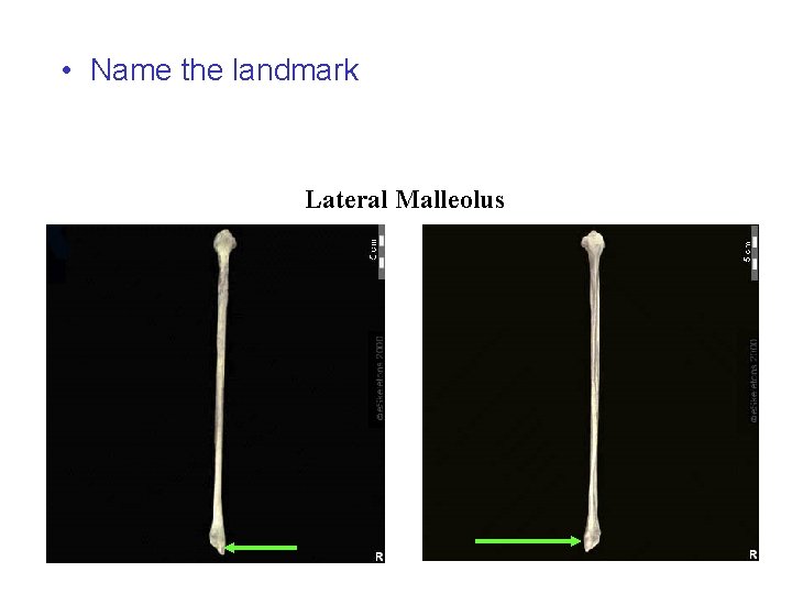  • Name the landmark Lateral Malleolus 