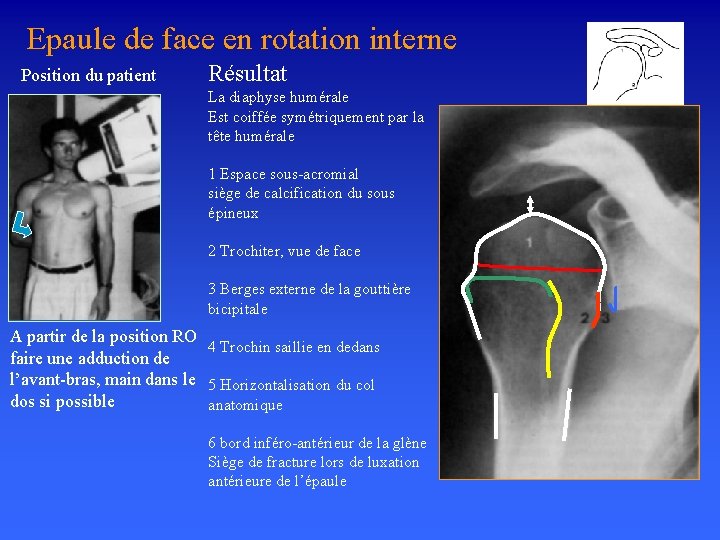 Epaule de face en rotation interne Position du patient Résultat La diaphyse humérale Est