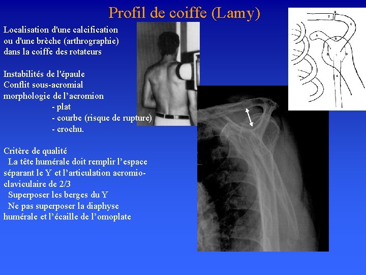 Profil de coiffe (Lamy) Localisation d'une calcification ou d'une brèche (arthrographie) dans la coiffe