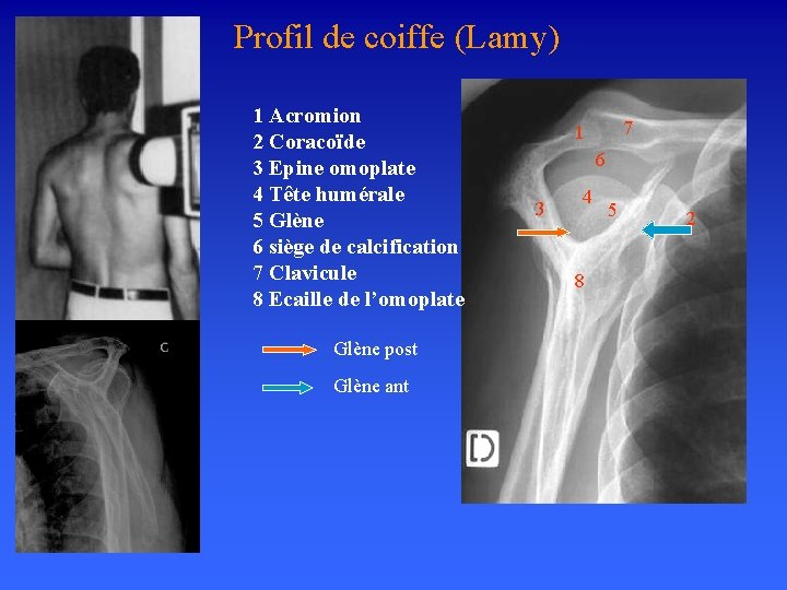 Profil de coiffe (Lamy) 1 Acromion 2 Coracoïde 3 Epine omoplate 4 Tête humérale