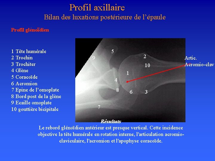  Profil axillaire Bilan des luxations postérieure de l’épaule Profil glénoïdien 1 Tête humérale