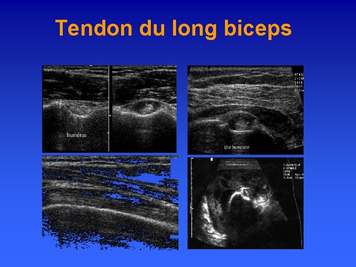 Tendon du long biceps 