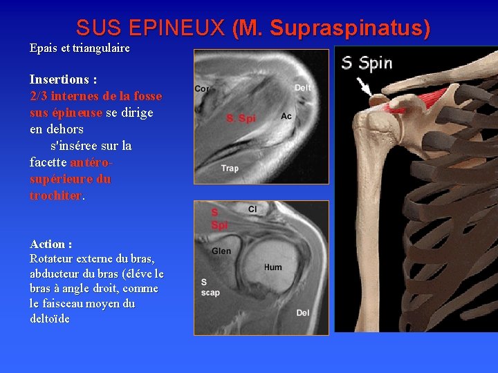 SUS EPINEUX (M. Supraspinatus) Epais et triangulaire Insertions : 2/3 internes de la fosse