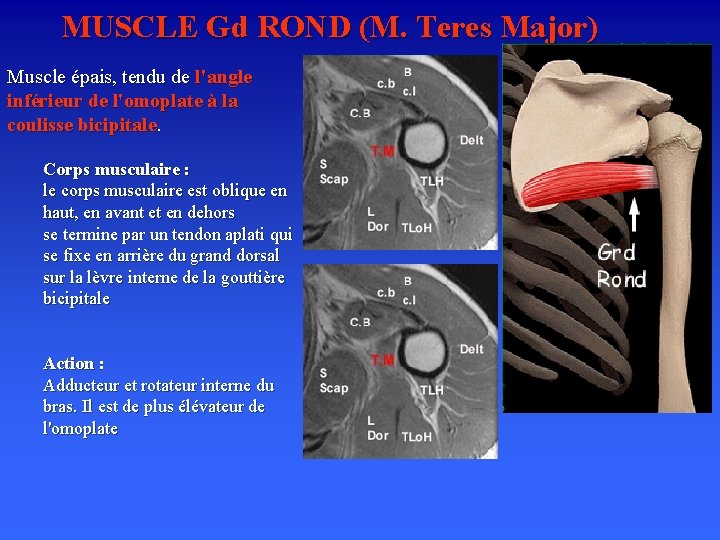 MUSCLE Gd ROND (M. Teres Major) Muscle épais, tendu de l'angle inférieur de l'omoplate