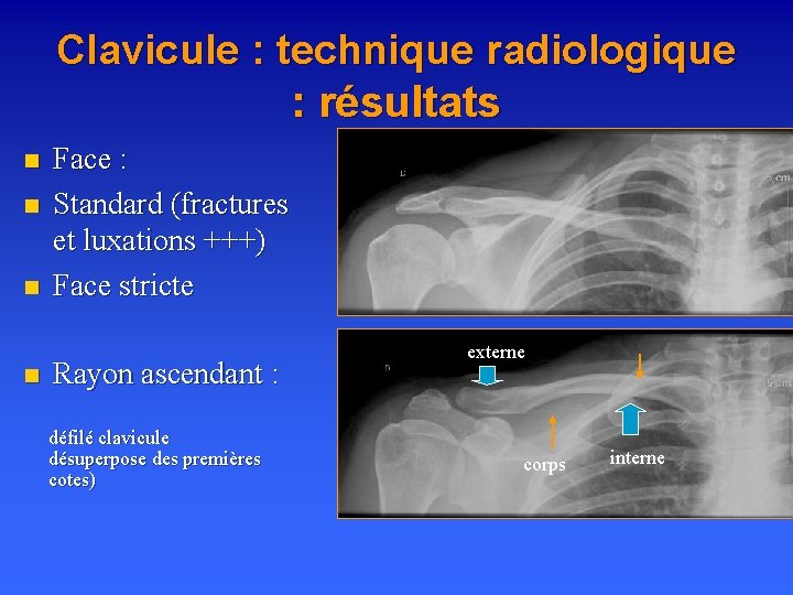 Clavicule : technique radiologique : résultats n n Face : Standard (fractures et luxations