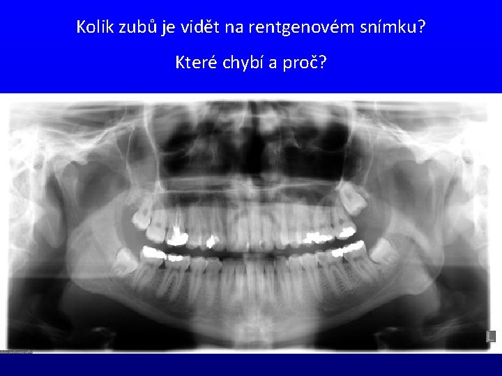 Kolik zubů je vidět na rentgenovém snímku? Které chybí a proč? 