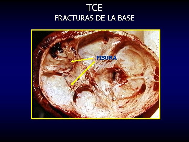 TCE FRACTURAS DE LA BASE FISURA 