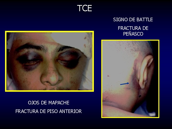 TCE SIGNO DE BATTLE FRACTURA DE PEÑASCO OJOS DE MAPACHE FRACTURA DE PISO ANTERIOR