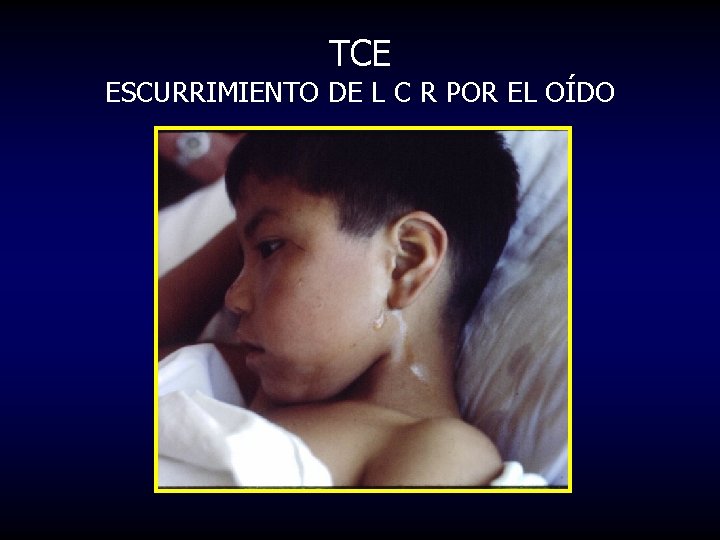 TCE ESCURRIMIENTO DE L C R POR EL OÍDO 