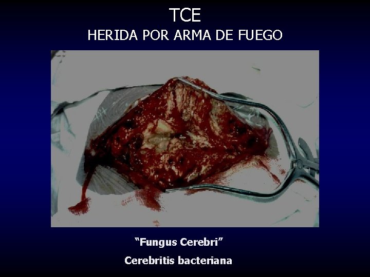 TCE HERIDA POR ARMA DE FUEGO “Fungus Cerebri” Cerebritis bacteriana 