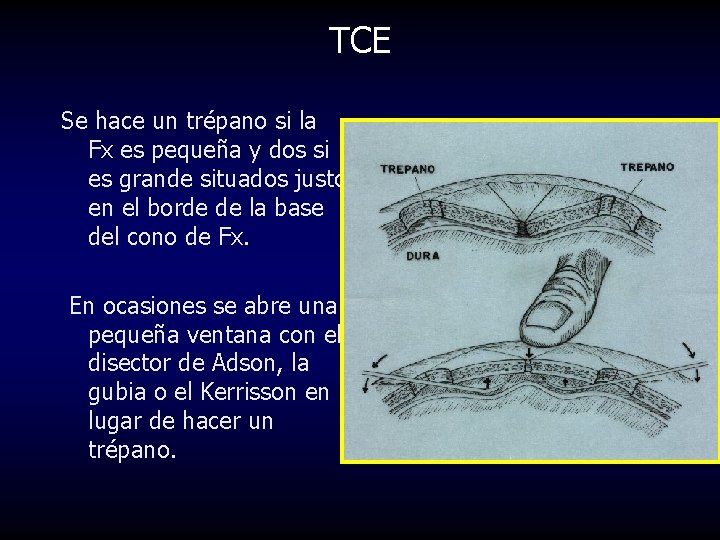 TCE Se hace un trépano si la Fx es pequeña y dos si es