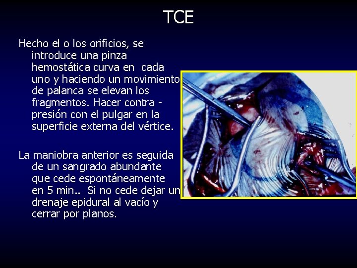 TCE Hecho el o los orificios, se introduce una pinza hemostática curva en cada