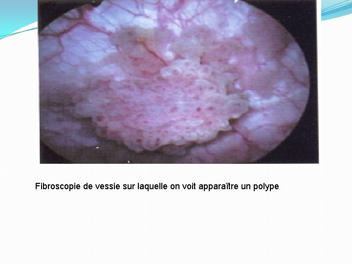 Fibroscopie de vessie sur laquelle on voit apparaître un polype 