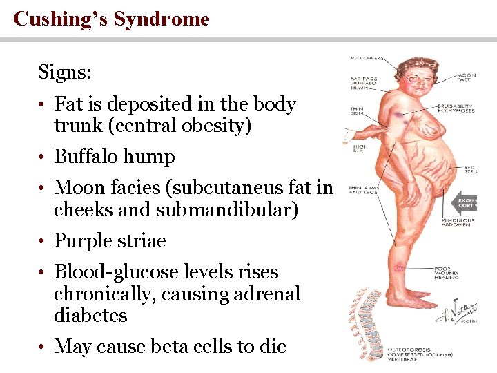 Cushing’s Syndrome Signs: • Fat is deposited in the body trunk (central obesity) • Cushing’s Syndrome Signs: • Fat is deposited in the body trunk (central obesity) •
