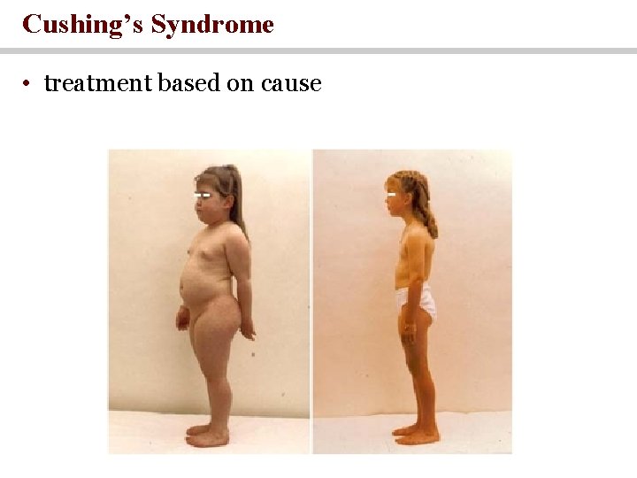 Cushing’s Syndrome • treatment based on cause Cushing’s Syndrome • treatment based on cause