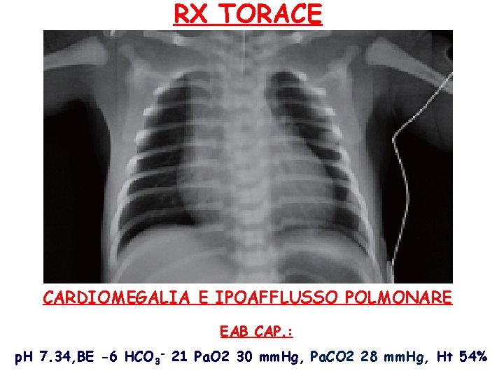 RX TORACE CARDIOMEGALIA E IPOAFFLUSSO POLMONARE EAB CAP. : p. H 7. 34, BE