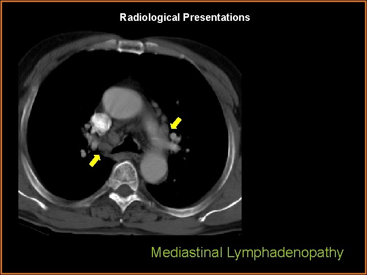 Radiological Presentations Mediastinal Lymphadenopathy 