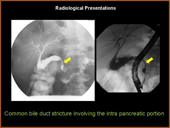 Radiological Presentations Common bile duct stricture involving the intra pancreatic portion 