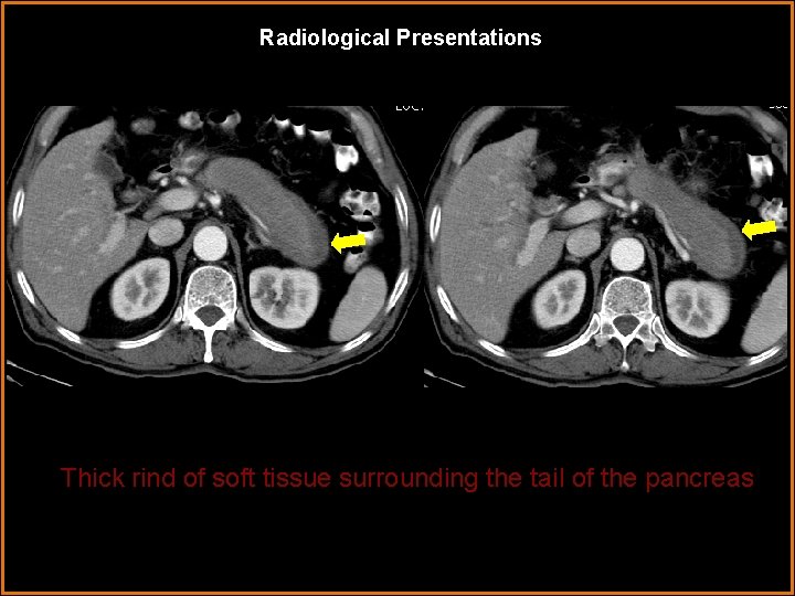 Radiological Presentations Thick rind of soft tissue surrounding the tail of the pancreas 