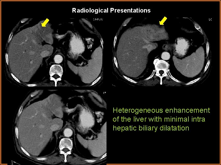 Radiological Presentations Heterogeneous enhancement of the liver with minimal intra hepatic biliary dilatation 