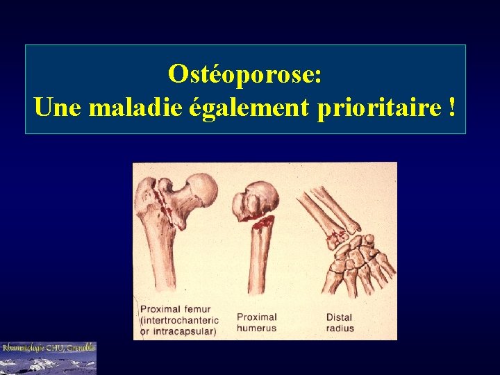 Ostéoporose: Une maladie également prioritaire ! 