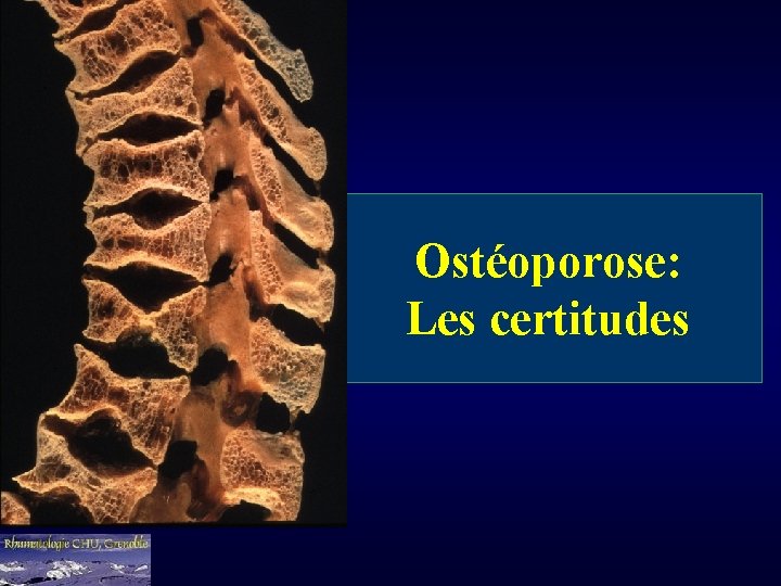 Ostéoporose: Les certitudes 